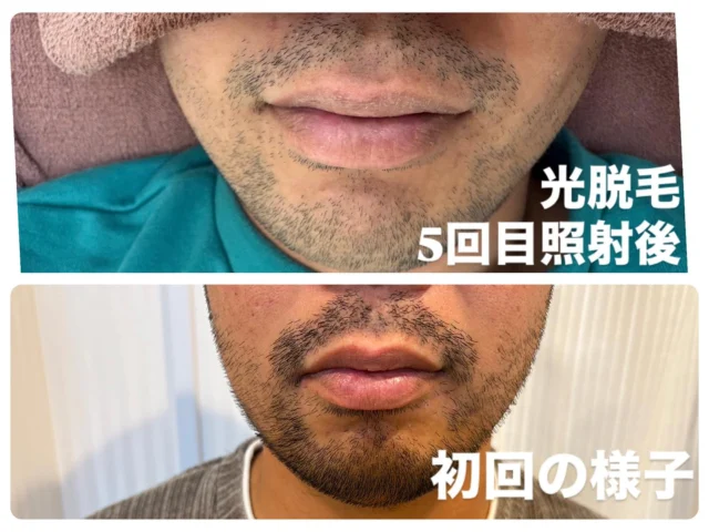 5回目照射で毛質に少し変化があり、毛の密度も薄くなってきました👀
通常ヒゲ脱毛の目安は30回程度
と言われています。
これから途中経過を上げていく予定ですのでぜひご覧ください♪